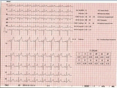 Máquina de monitor de ECG EKG de 3 canales y 12 derivaciones