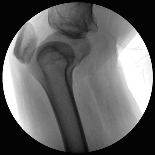 Sistema de brazo en C de rayos X móvil de alta frecuencia de 6KW 120mA