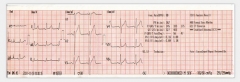 Máquina de monitor de ECG EKG de 3 canales y 12 derivaciones